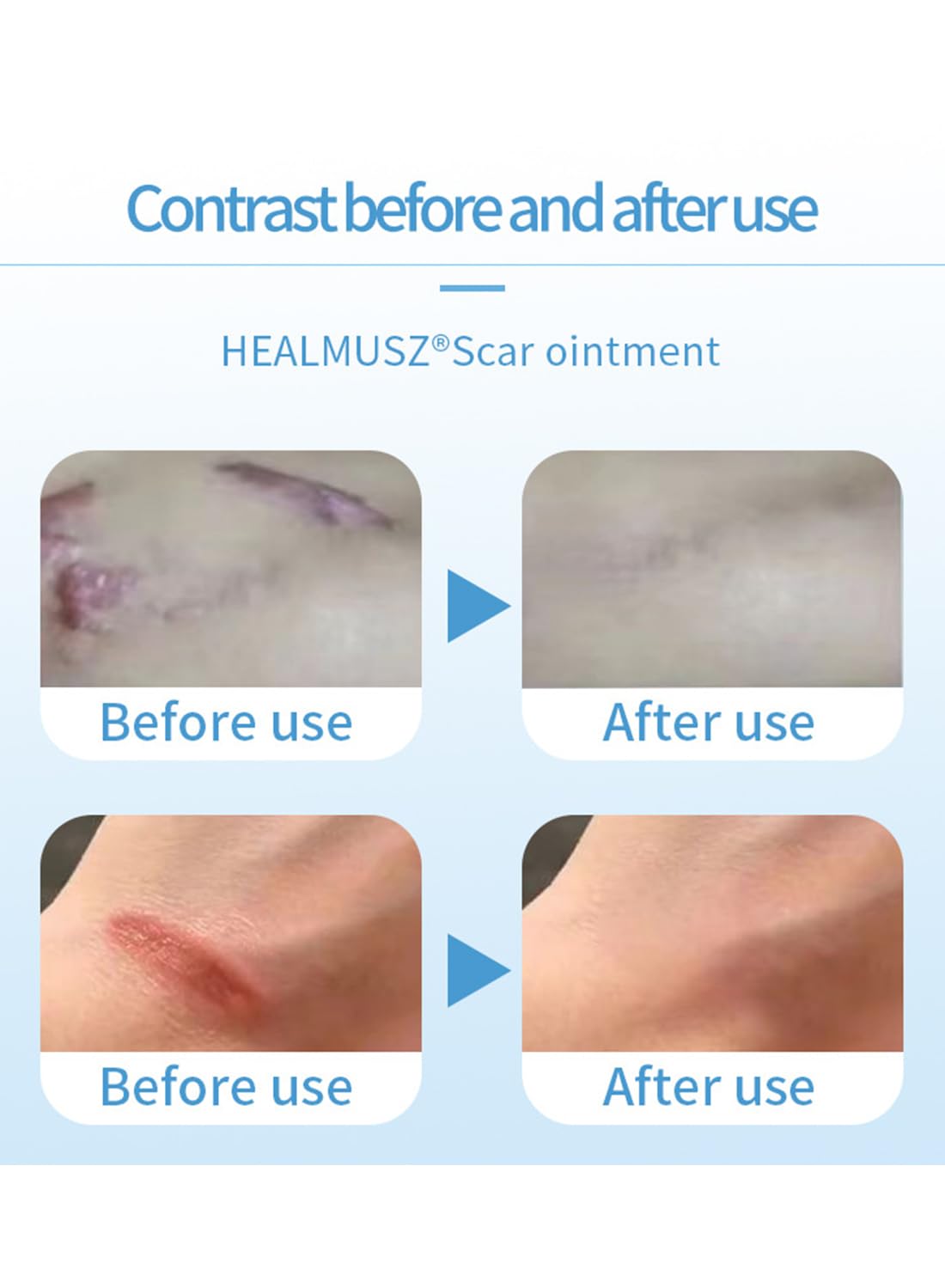 Scar Treatment Effective Safe Scar Removal Cream to Soften and Flatten Scar 20g