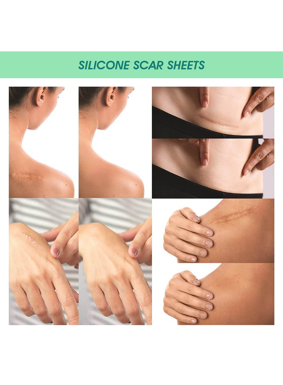 ELAIMEI Silicone Scar Sheets Skin Care 4Pcs