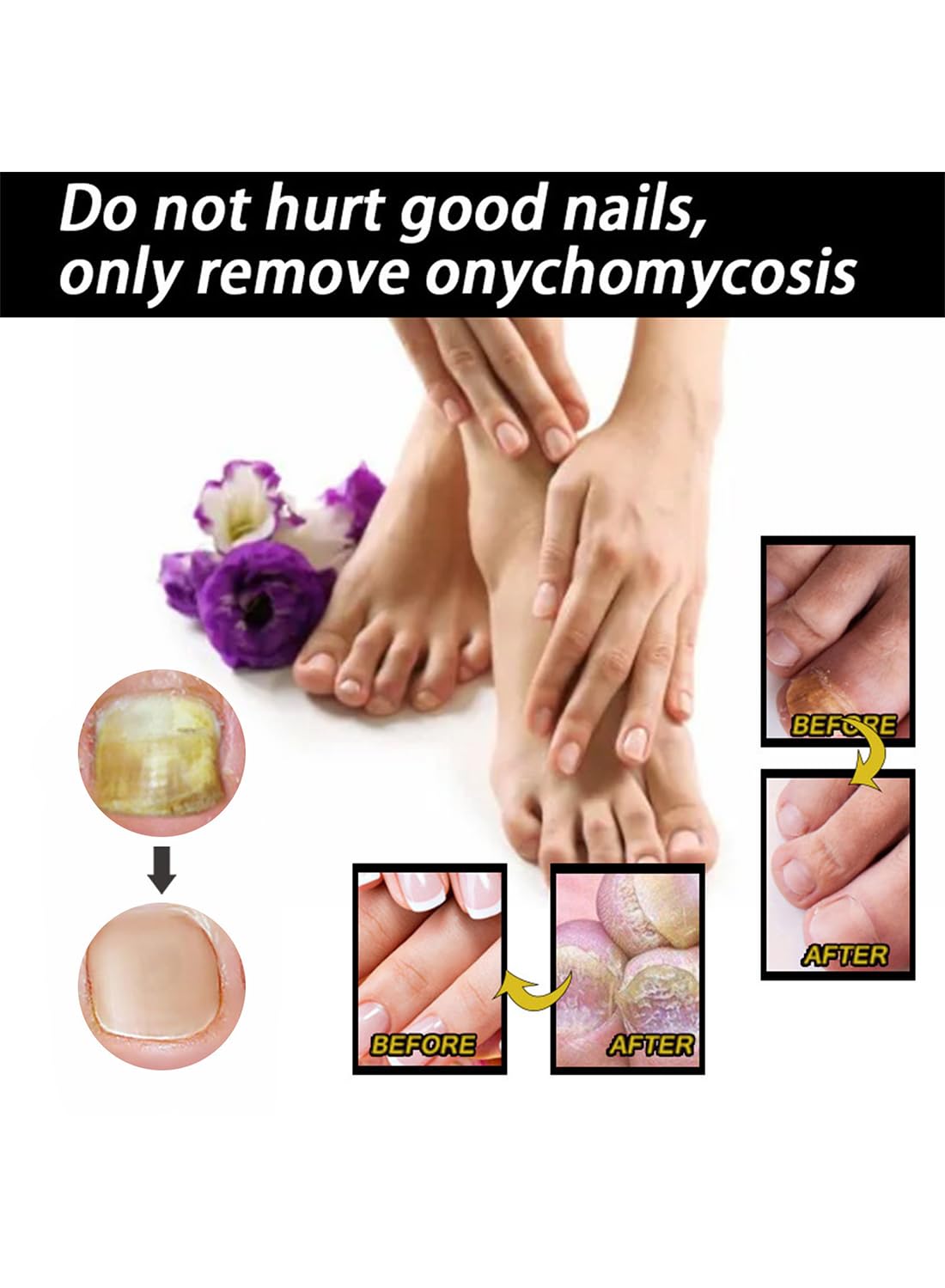 Nail Repair Treatment, Quickly Effective Nail Fungal Oil for Hands and Feet - 30ml