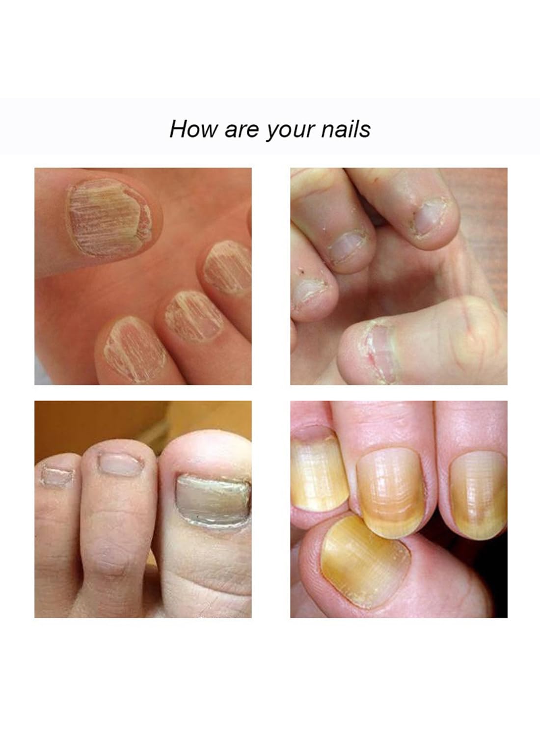 Nail Repair Cream, Nail Grooming Gel for Onychomycosis and Damaged Nails 20 ml
